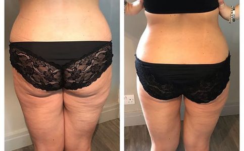 bum and legs before and after